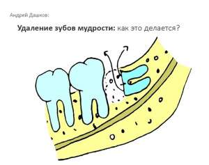 Удаление зубов мудрости. Как это делается?