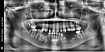 Случай девушки без трёх зубов: как наращивается кость перед установкой импланта; зачем и как организм меняет скелет