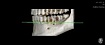 Современная стоматология: одномоментная имплантация зуба и наращивание челюстной кости глазами технического директора
